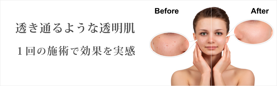 透き通るような透明肌 １回の施術で効果を実感